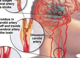 TÌM HIỂU VỀ TAI BIẾN MẠCH MÁU NÃO